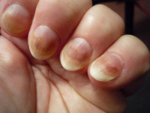 грибок ногтей на пальцах рук