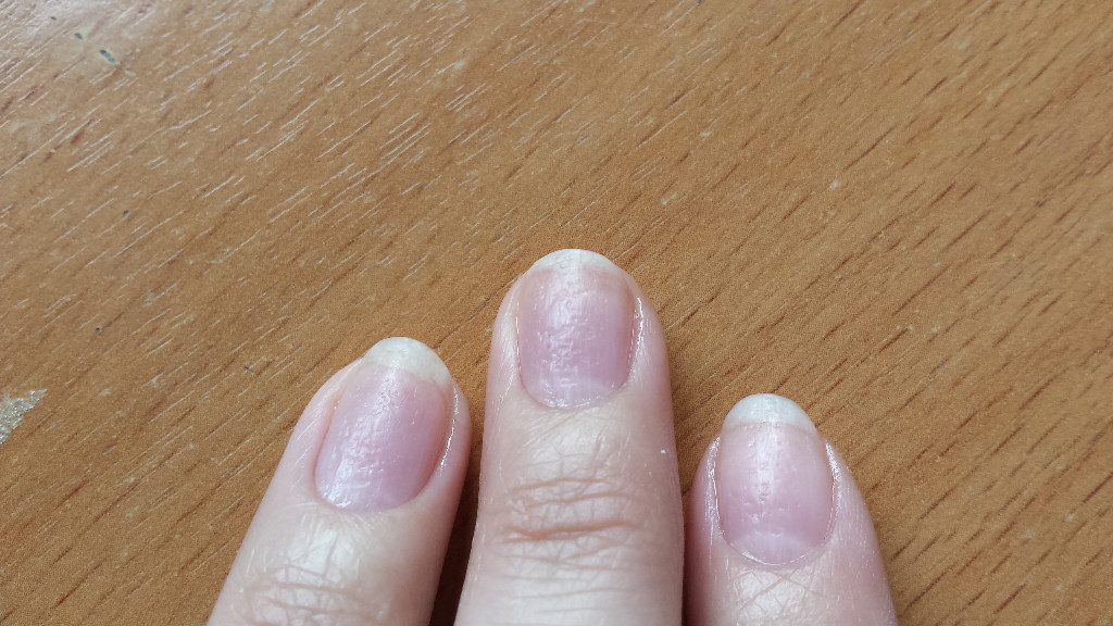 Почему ногти синеют причина. Мелкие углубления на ногтях рук. Пупырышки около ногтей на руках. Ногти на руках в мелких вмятинах.