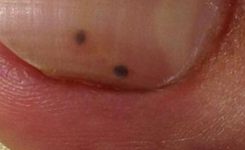 Маленькие черные точки на ногте