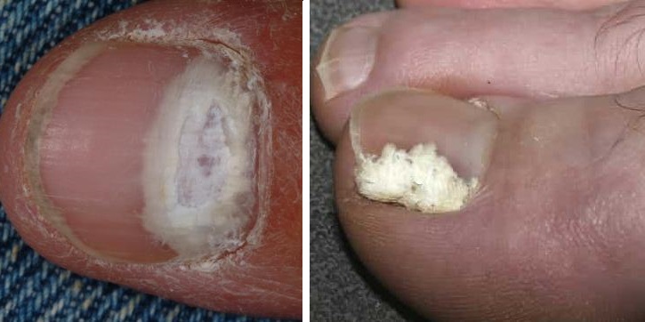 Белые пятна от грибка на ногтях ног