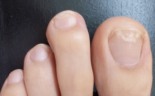Белые пятна на ногтях ног из-за дефицита питательных веществ
