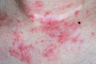 Atopic eczema blotchy red rash on chest and neck