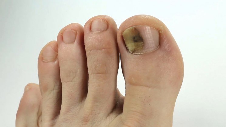 болезни ногтей на ногах