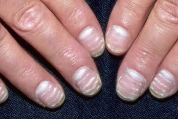 белые полоски на ногтях