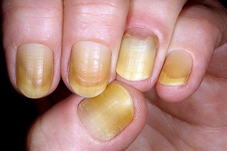 почему ногти желтеют
