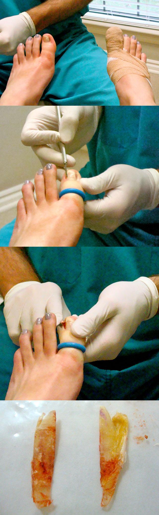 лечение вросшего ногтя на ноге