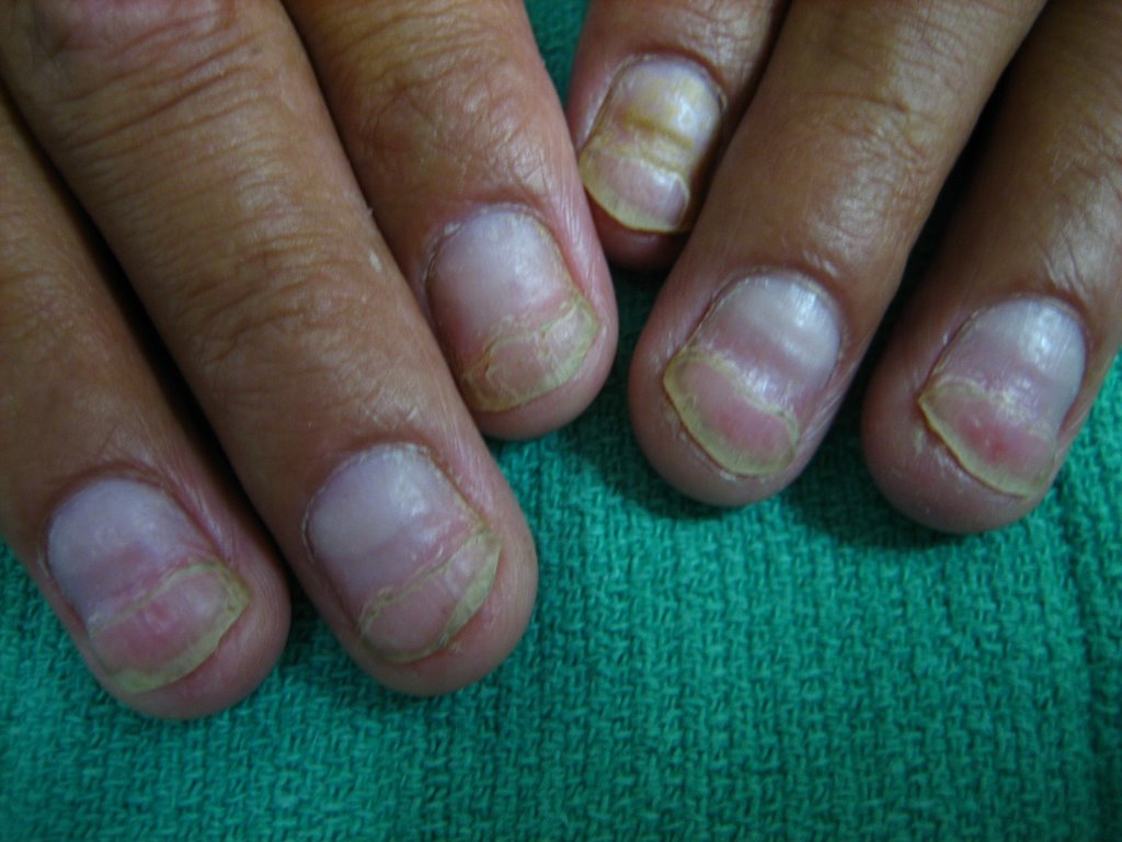 Лечение продольных полос на ногтях. Продольные полосы на ногтях. Псориаз ногтей с полосками.
