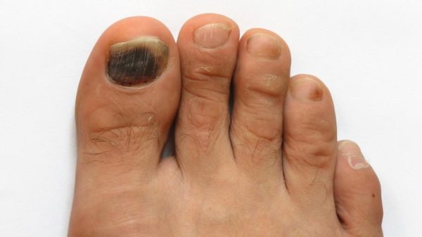 Черное пятно на ногте большого пальца ноги