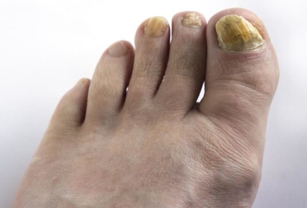 Желтые ногти на ногах