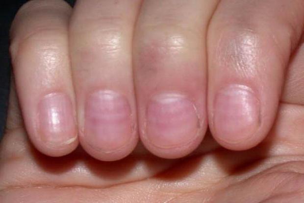 диагностика по ногтям пальцев рук