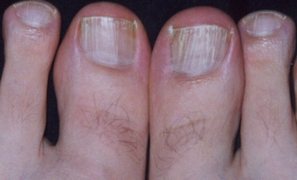 white-toenails-pictures-2
