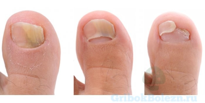 формы ногтя