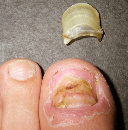 toenail falling off 2