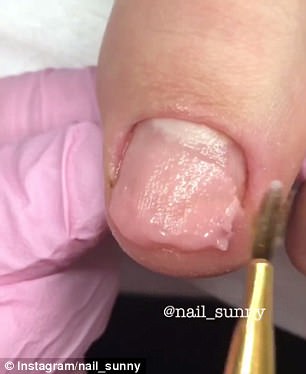 Addictive: The nail technician worked true magic with the broken and fungus-infected toenails using a variety of tools