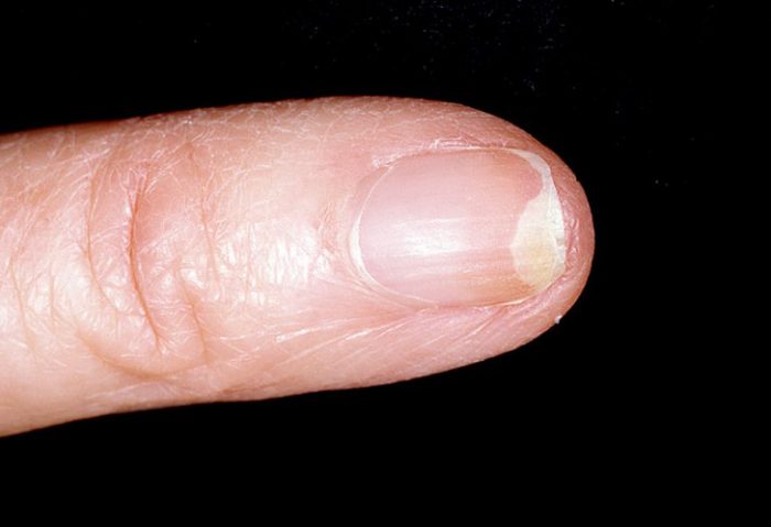 онихолизис ногтей