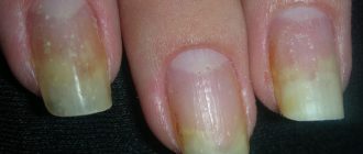 изменения ногтевой пластины