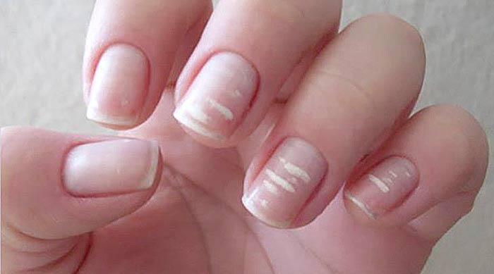 Белые пятна на ногтях пальцев рук причина у женщин