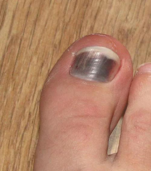 Черная точка под ногтем на большом пальце ноги. Черные пятна на ногтях: причины и лечение