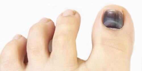 Черные точки под ногтем большого пальца ноги. Что могут означать темные пятна на ногтях больших пальцев ног