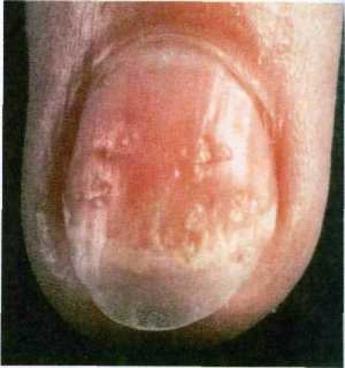 Точечные углубления на ногтях. Причины и лечение наперстковидной (точечной) истыканности ногтей