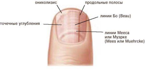 Вмятины на ногтях в виде точек. Почему появляются ямки и дырочки на ногтях, о чем они говорят