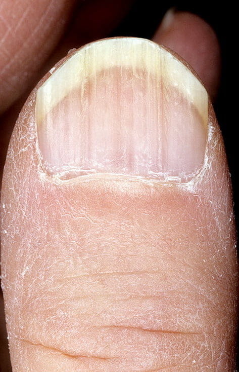 Полоски на ногтях причины вертикальные у женщин. Ониходистрофия - онихолизис.. Ониходистрофия экзема. Борозды бо-Рейля (линии бо). Поперечные борозды бо-Рейли.