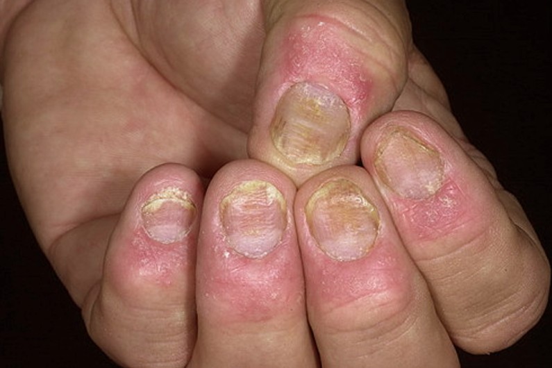 nail psoriasis 3