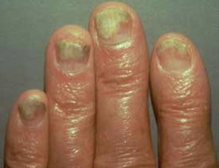 nail psoriasis 5