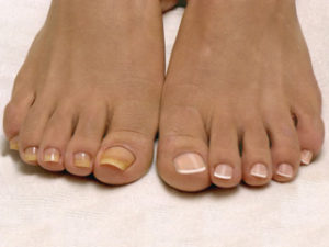 Лечение ногтей ног