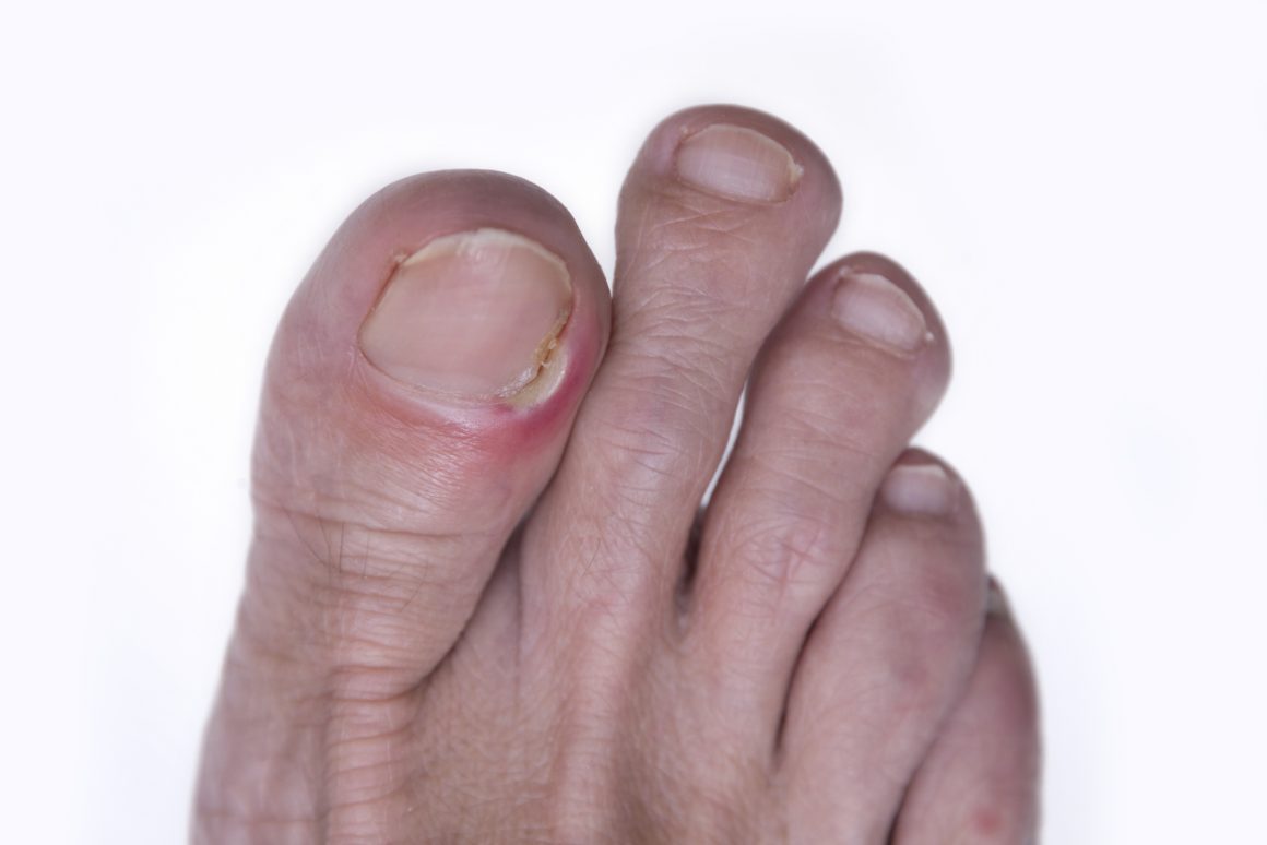 Нарывает палец на ноге около ногтя