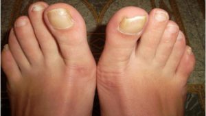 Желтые ногти ног