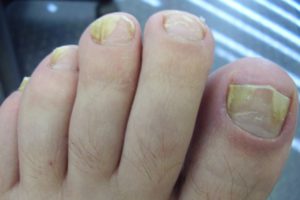 Расслоение ногтей на пальцах ног
