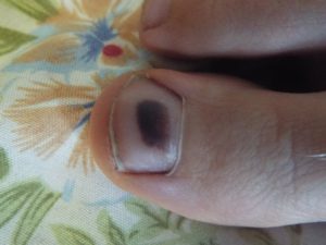 Черное пятно – результат травмы