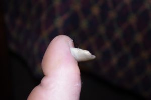 Отслоение ногтевой пластины