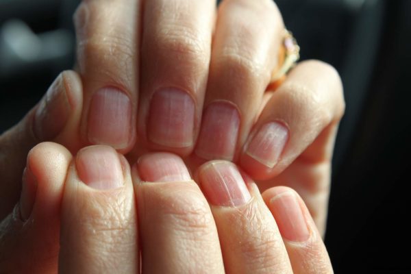 Волнистые ногти на руках: причины и методы лечения, фото