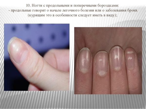 Волнистые ногти на руках: причины и методы лечения, фото
