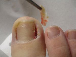 Хирургия воспаления валика у ногтя