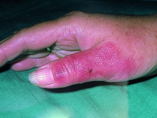 Рожистое воспаление пальца руки