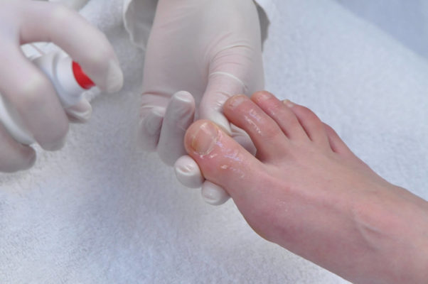 Псориаз ногтей лечение