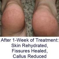 cracked heels fissures after treatment