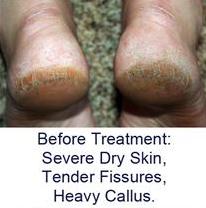 cracked heels fissures before treatment
