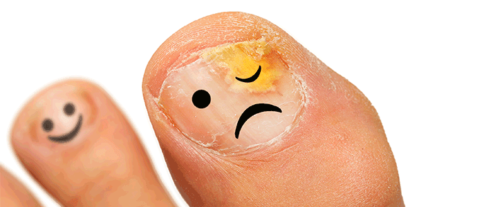 My toenail is falling off, Los Angeles Podiatrist