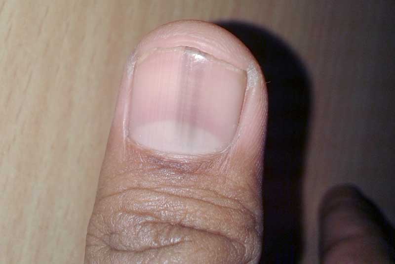 Полоски на ногтях причины вертикальные у женщин. Продольная меланонихия. Подноктевавая меланома. Подногтевая меланома белая.