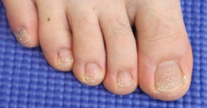 White chalky toenails from toenail polish