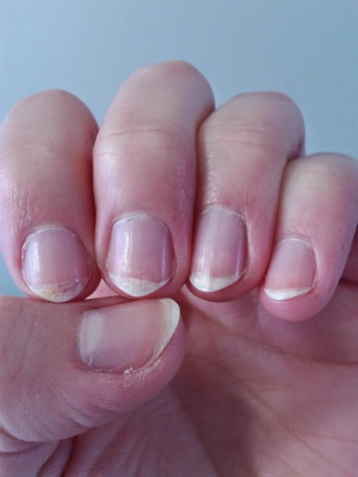 На ногтях коричневые пятна: Болезненные коричневые пятна на ногтях рук .